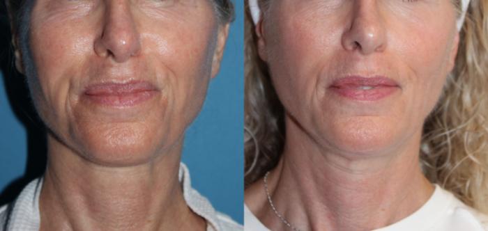Before & After Laser Skin Rejuvenation Case 217 Front View in Coeur d'Alene, ID