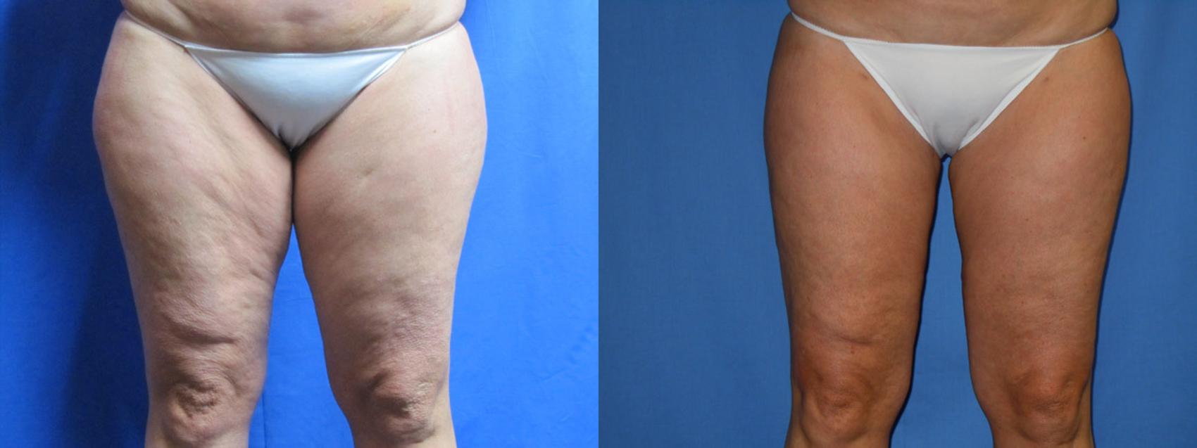 Before & After Liposuction - Inner and/or Outer Thighs Case 2 View #1 View in Coeur d'Alene, ID