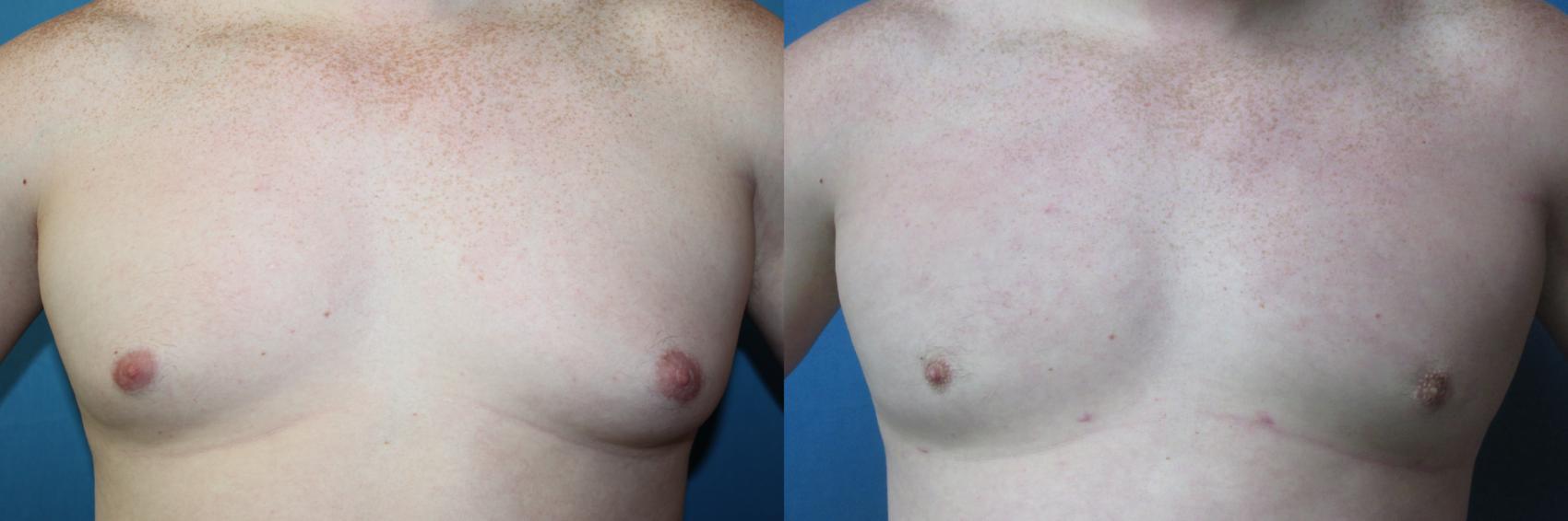Before & After Liposuction - Male Chest Case 216 Front View in Coeur d'Alene, ID