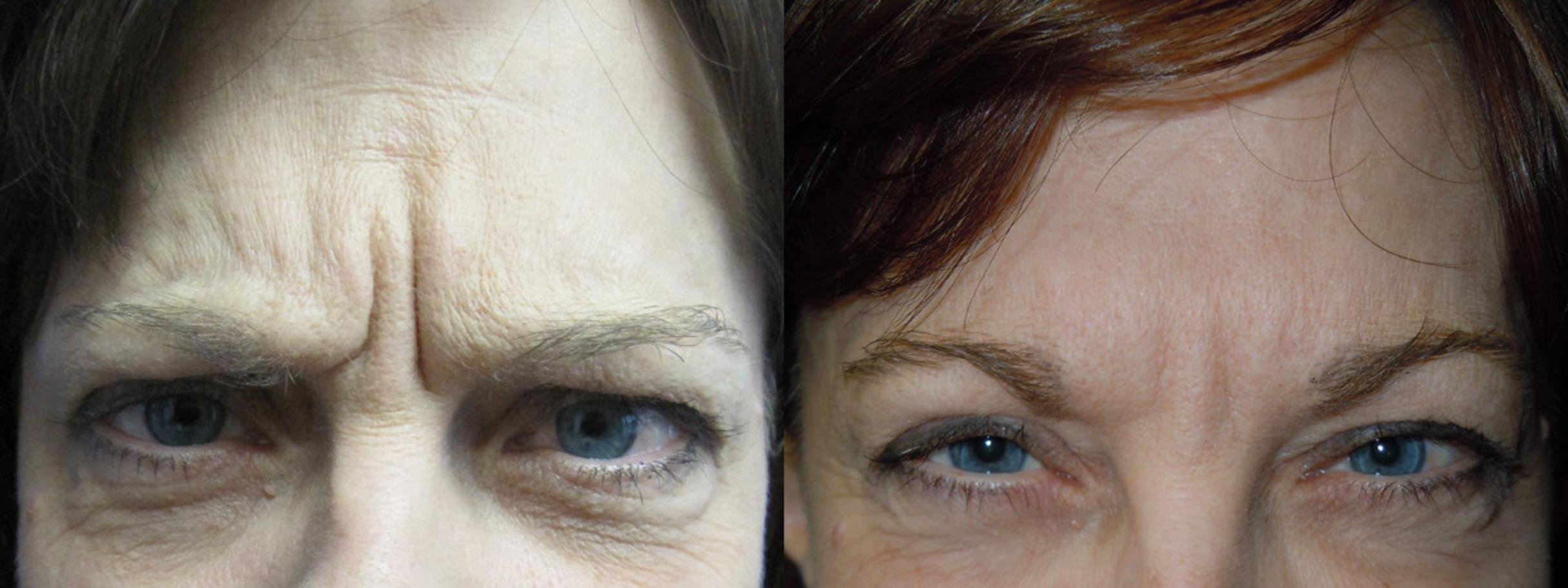 Before & After BOTOX® Cosmetic / Dysport Case 1 View #1 View in Coeur d'Alene, ID