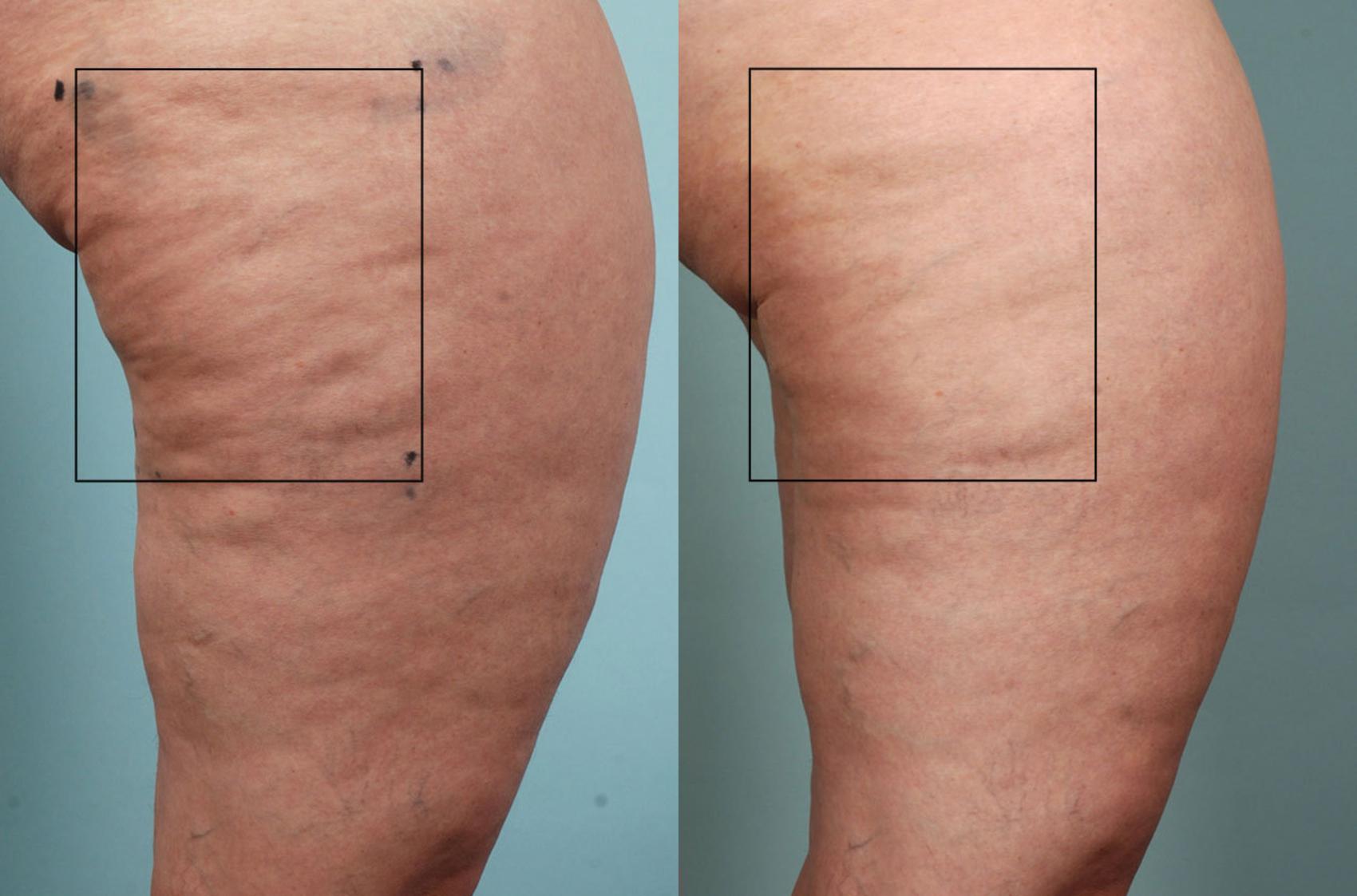 Before & After Cellulite Reduction Case 33 View #1 View in Coeur d'Alene, ID