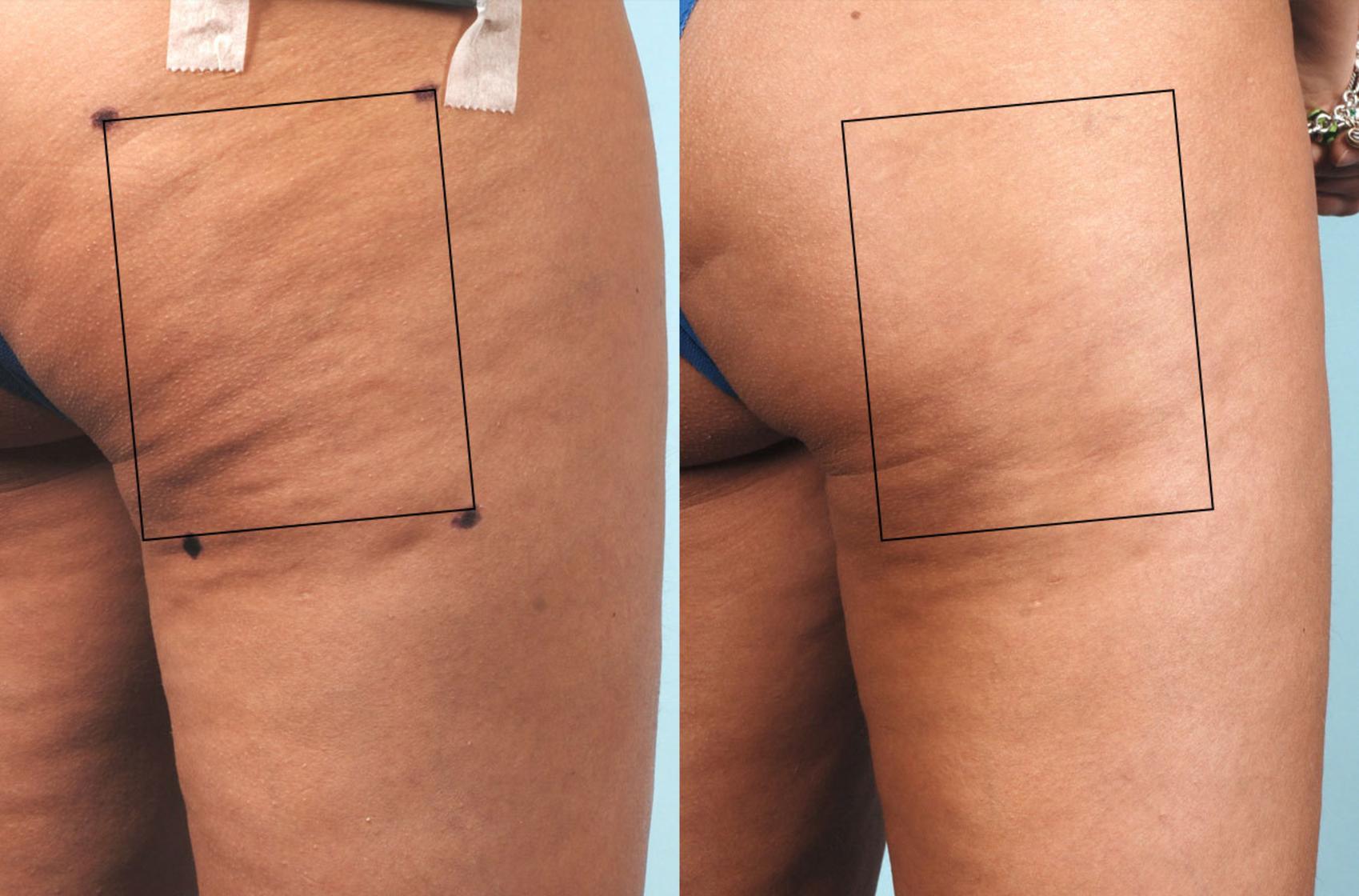 Before & After Cellulite Reduction Case 34 View #1 View in Coeur d'Alene, ID