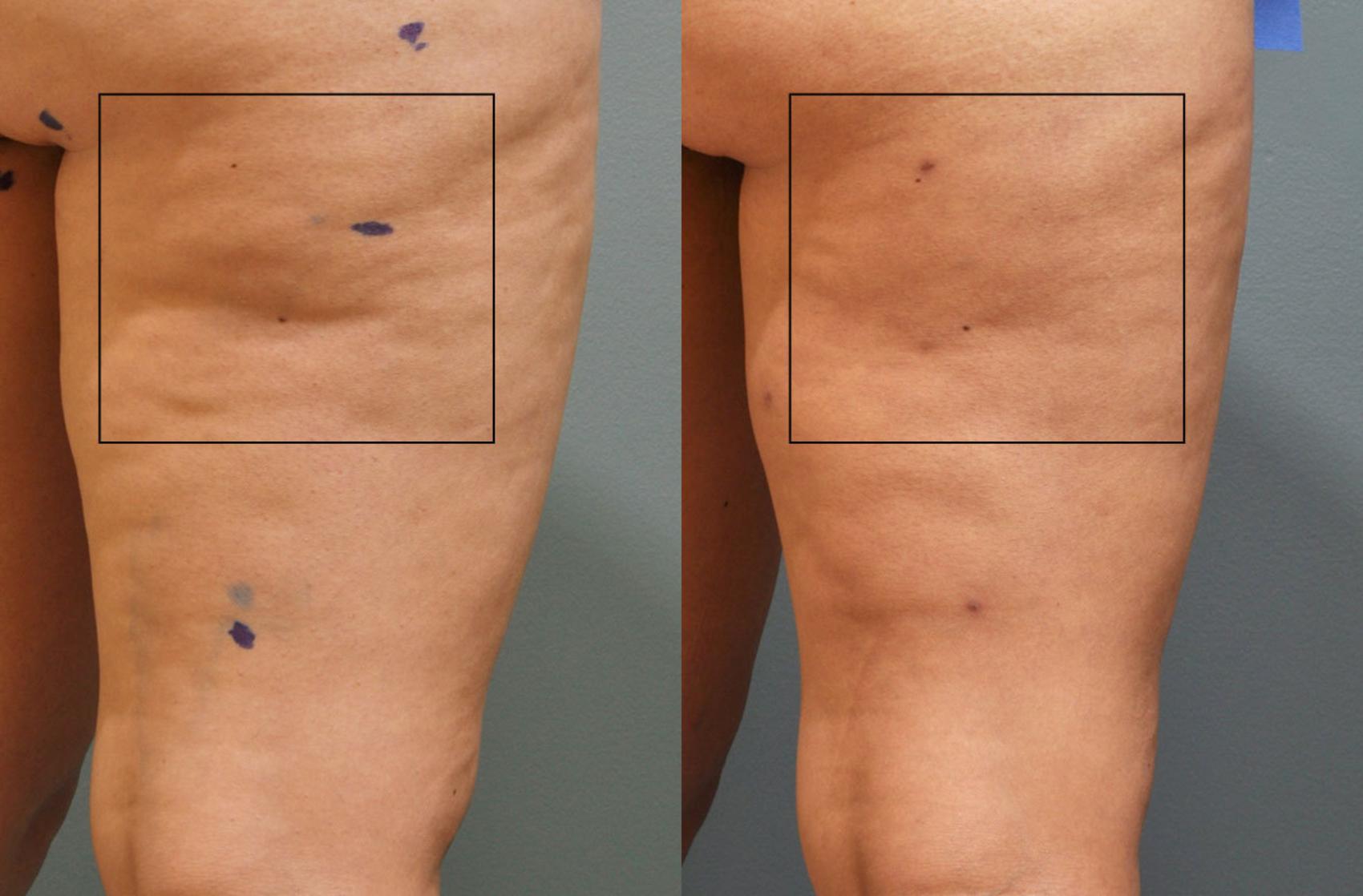 Before & After Cellulite Reduction Case 35 View #1 View in Coeur d'Alene, ID