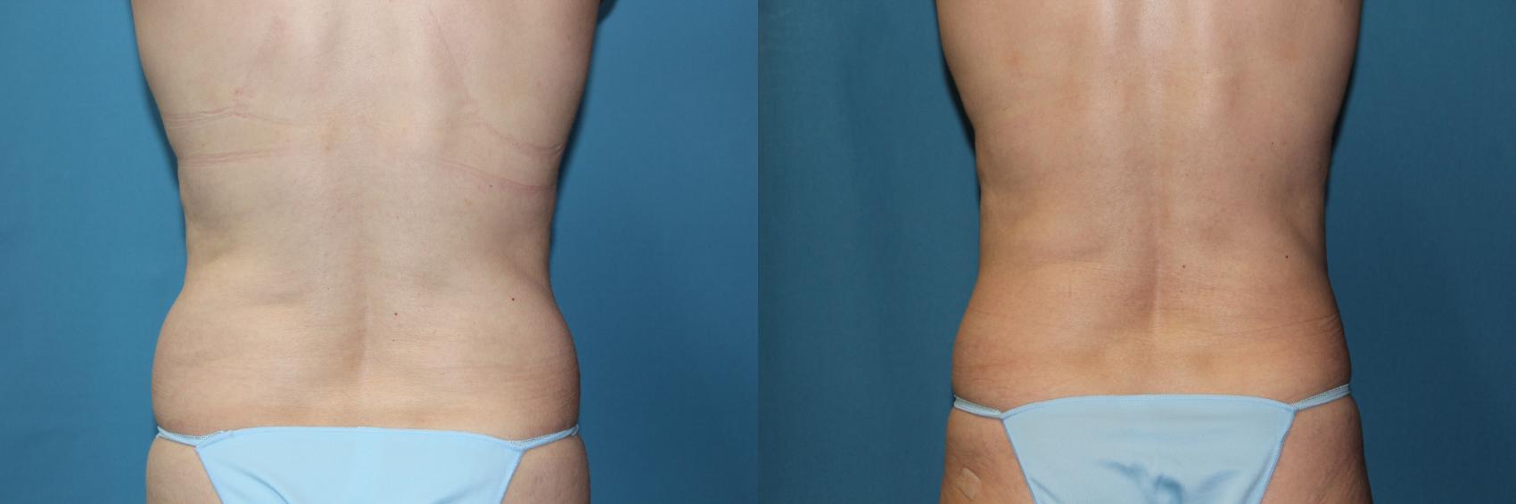 Before & After CoolSculpting® Case 188 Back View in Coeur d'Alene, ID