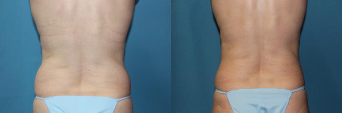 Before & After CoolSculpting® Case 188 Back View in Coeur d'Alene, ID