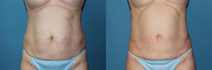 Before & After CoolSculpting® Case 188 Front View in Coeur d'Alene, ID