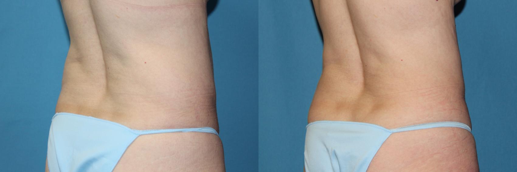 Before & After CoolSculpting® Case 188 Left Oblique View in Coeur d'Alene, ID