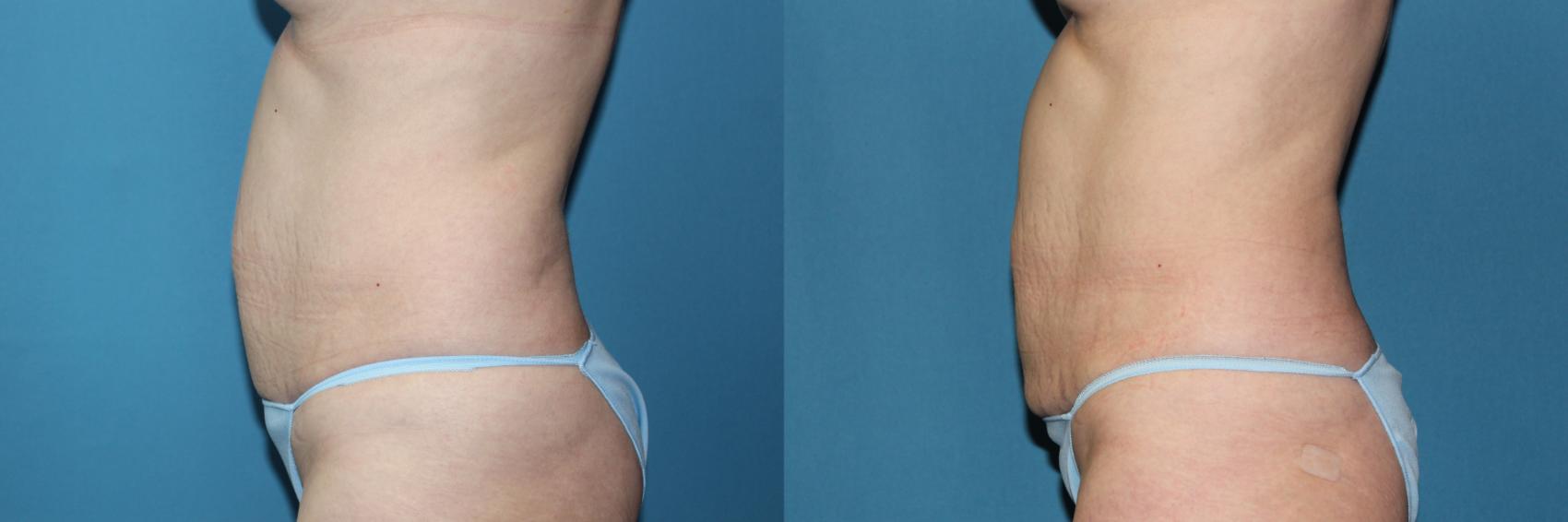 Before & After CoolSculpting® Case 188 Left Side View in Coeur d'Alene, ID