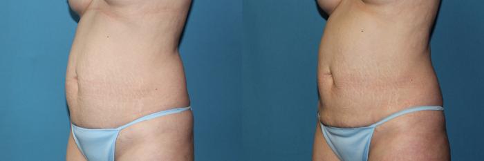 Before & After CoolSculpting® Case 188 Left Side Front Oblique View in Coeur d'Alene, ID