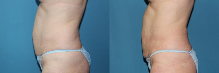 Before & After CoolSculpting® Case 188 Left Side View in Coeur d'Alene, ID