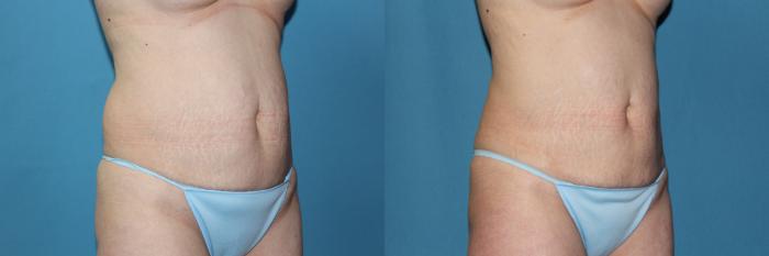 Before & After CoolSculpting® Case 188 Right Oblique View in Coeur d'Alene, ID