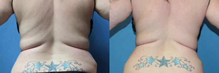 Before & After CoolSculpting® Case 209 Back View in Coeur d'Alene, ID