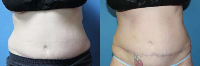 Before & After CoolSculpting® Case 209 Front View in Coeur d'Alene, ID