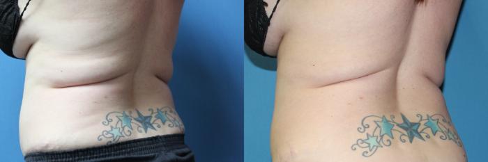 Before & After CoolSculpting® Case 209 Left Oblique View in Coeur d'Alene, ID