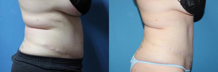 Before & After CoolSculpting® Case 209 Left Side View in Coeur d'Alene, ID