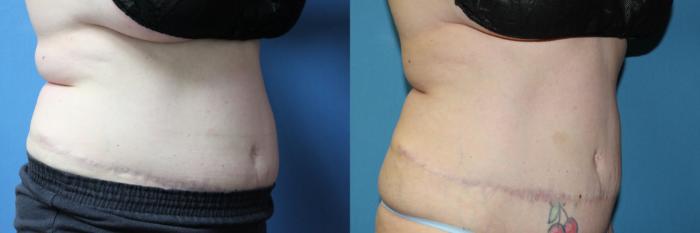 Before & After CoolSculpting® Case 209 Right Oblique View in Coeur d'Alene, ID