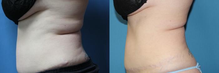 Before & After CoolSculpting® Case 209 Right Side View in Coeur d'Alene, ID