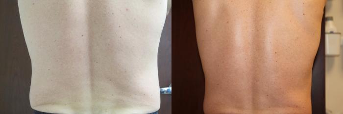 Before & After CoolSculpting® Case 220 Back View in Coeur d'Alene, ID