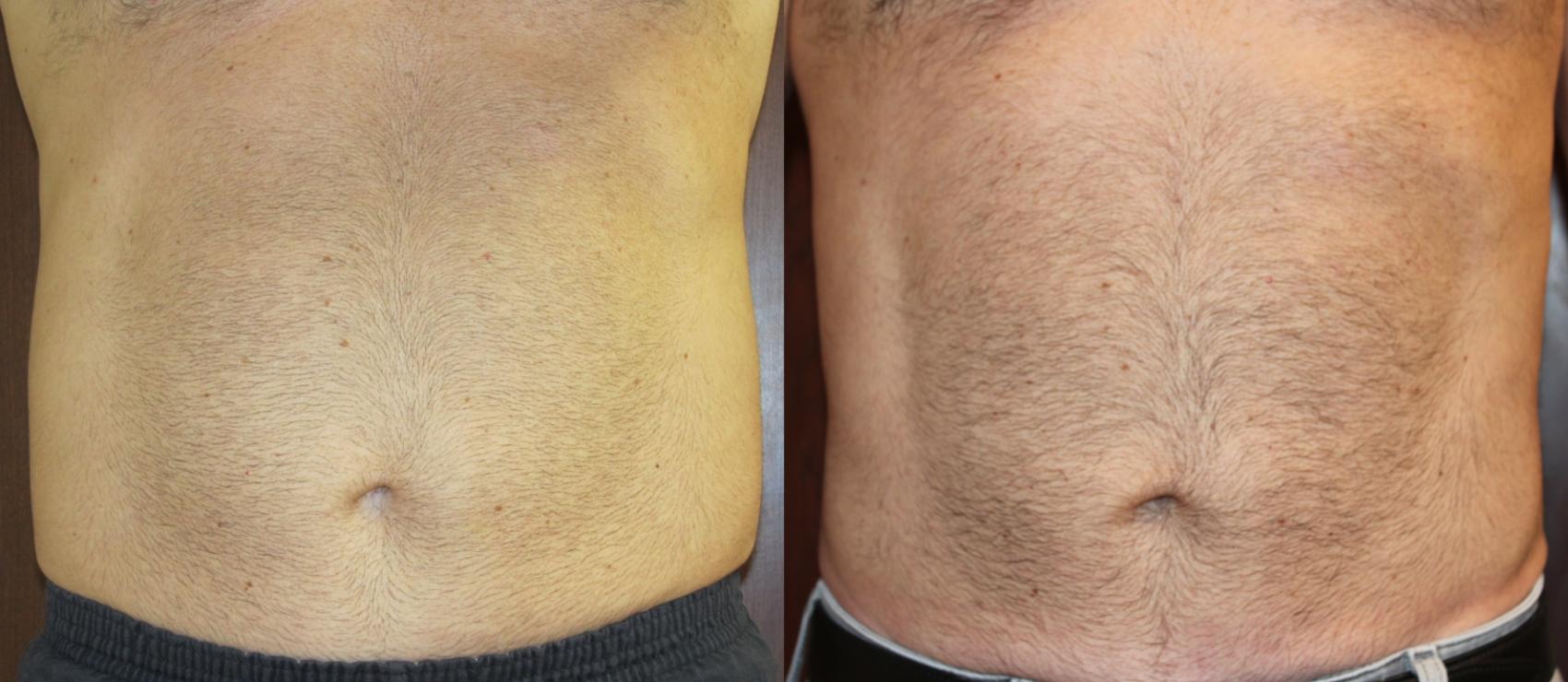 Before & After CoolSculpting® Case 220 Front View in Coeur d'Alene, ID