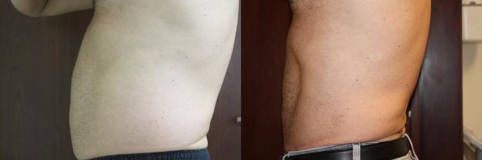 Before & After CoolSculpting® Case 220 Left Side View in Coeur d'Alene, ID