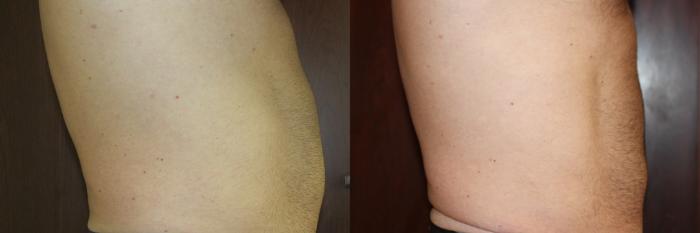 Before & After CoolSculpting® Case 220 Right Side View in Coeur d'Alene, ID