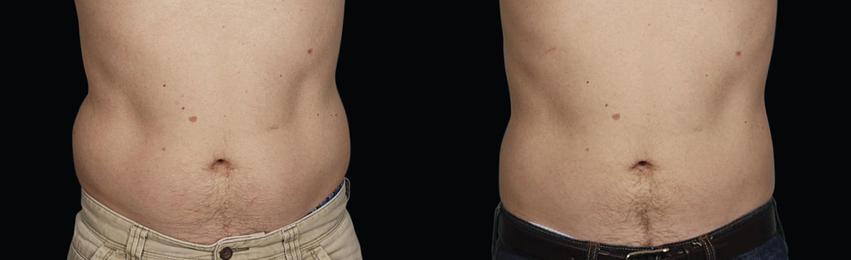 Before & After CoolSculpting® Case 37 View #1 View in Coeur d'Alene, ID