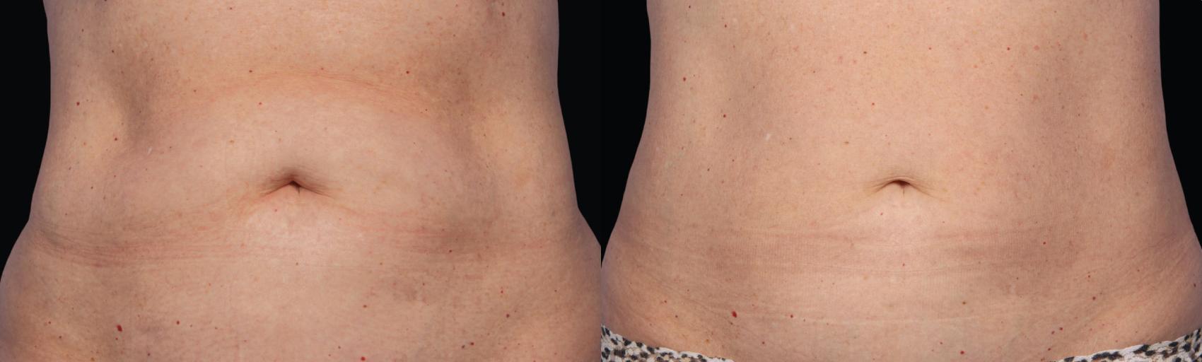 Before & After CoolSculpting® Case 38 View #1 View in Coeur d'Alene, ID