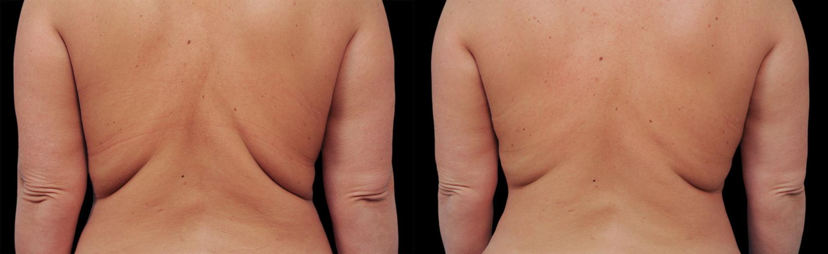 Before & After CoolSculpting® Case 39 View #1 View in Coeur d'Alene, ID