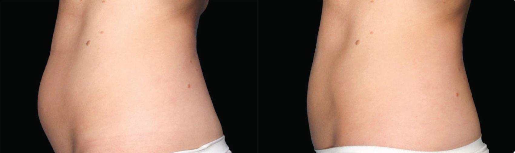 Before & After CoolSculpting® Case 40 View #1 View in Coeur d'Alene, ID