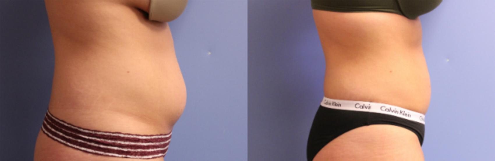 Before & After CoolSculpting® Case 95 View #1 View in Coeur d'Alene, ID
