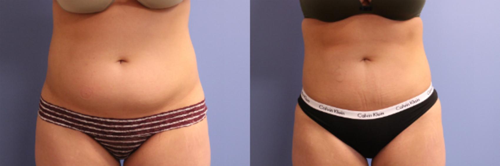 Before & After CoolSculpting® Case 95 View #2 View in Coeur d'Alene, ID