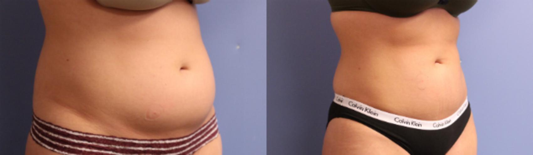 Before & After CoolSculpting® Case 95 View #3 View in Coeur d'Alene, ID