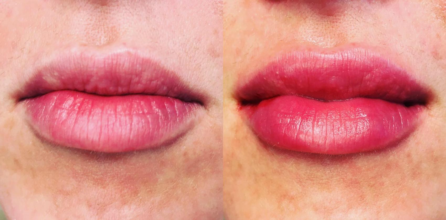 Before & After Dermal Fillers Case 124 View #1 View in Coeur d'Alene, ID
