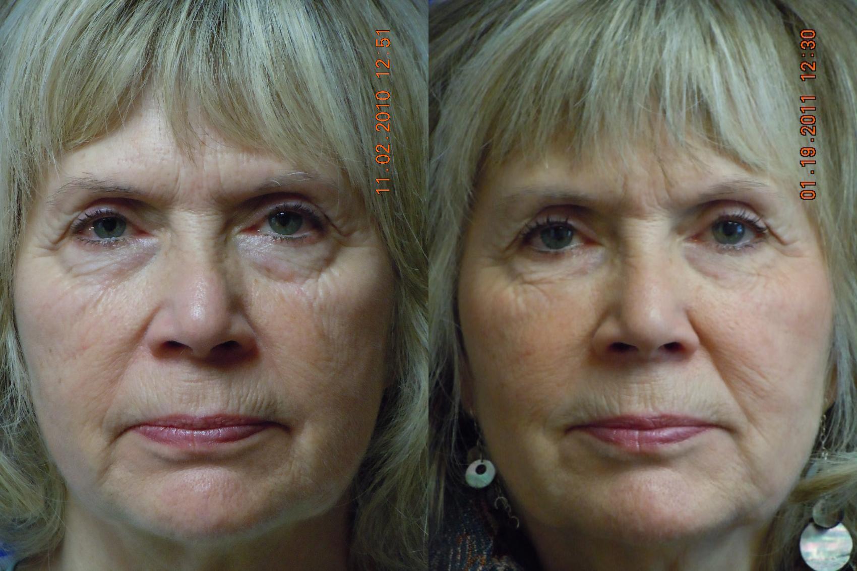 Before & After Dermal Fillers Case 16 View #1 View in Coeur d'Alene, ID