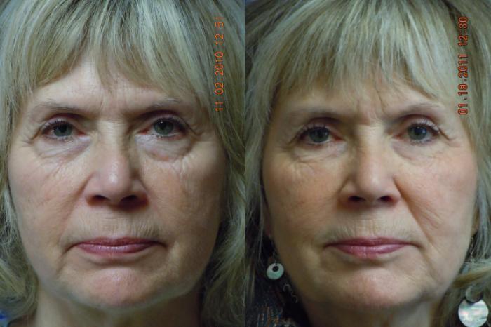 Before & After Dermal Fillers Case 16 View #1 View in Coeur d'Alene, ID