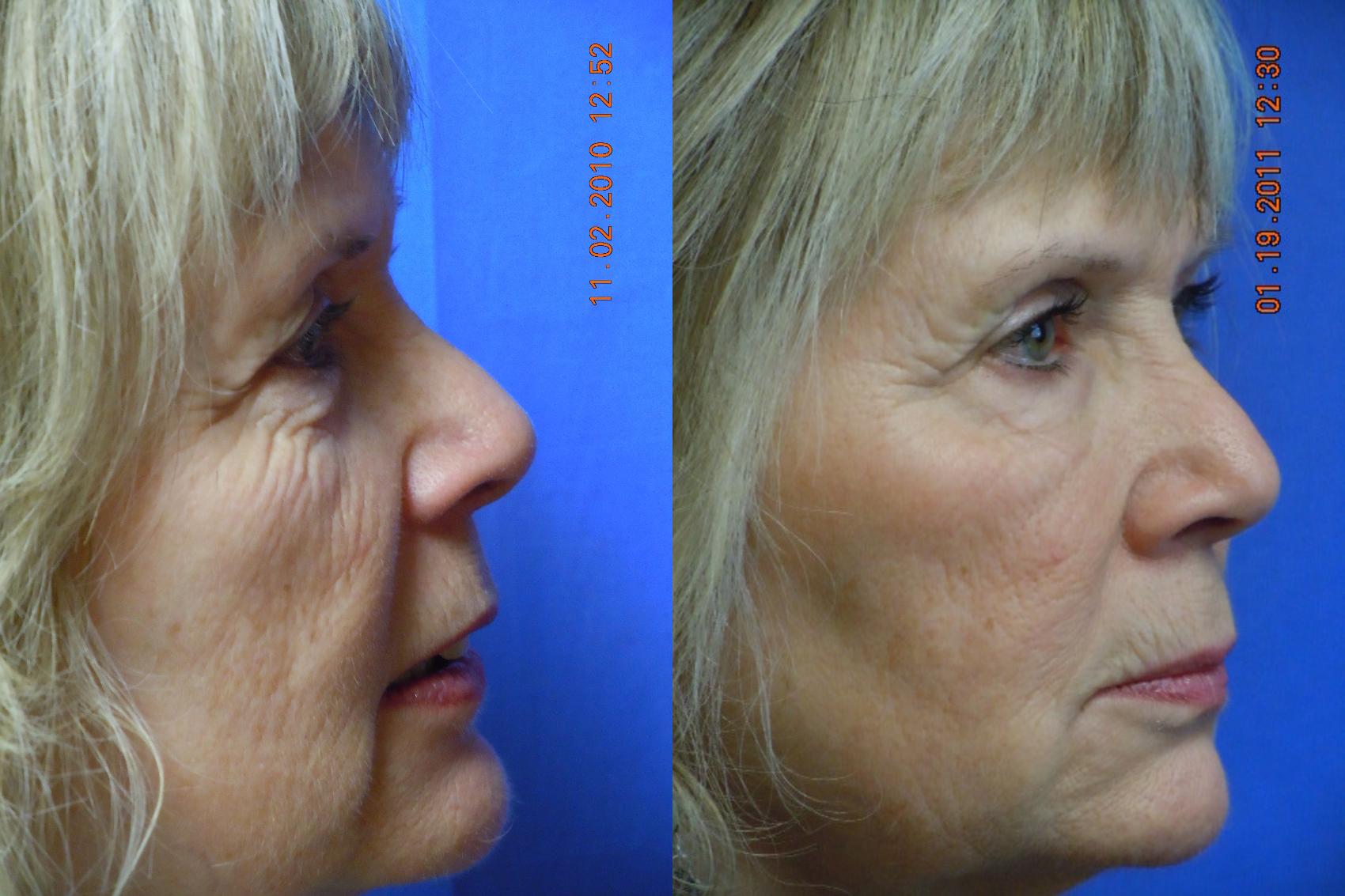 Before & After Dermal Fillers Case 16 View #2 View in Coeur d'Alene, ID