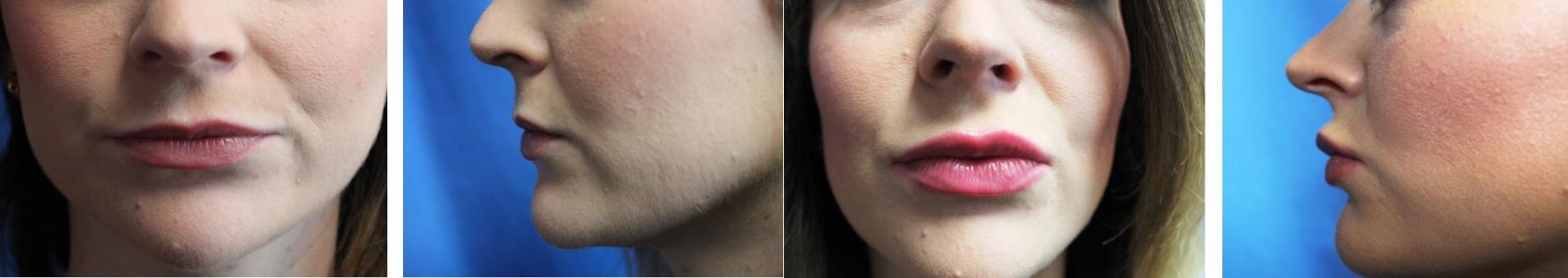 Before & After Dermal Fillers Case 51 View #1 View in Coeur d'Alene, ID
