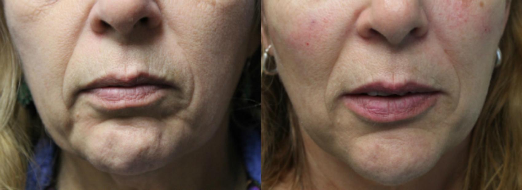 Before & After Dermal Fillers Case 56 View #1 View in Coeur d'Alene, ID