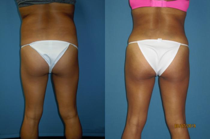 Before & After Liposuction - Abdomen / Flanks Case 139 View #1 View in Coeur d'Alene, ID