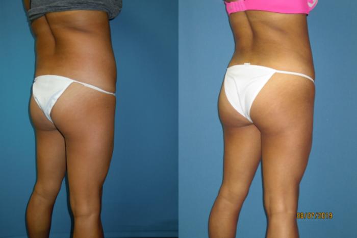 Before & After Liposuction - Abdomen / Flanks Case 139 View #2 View in Coeur d'Alene, ID
