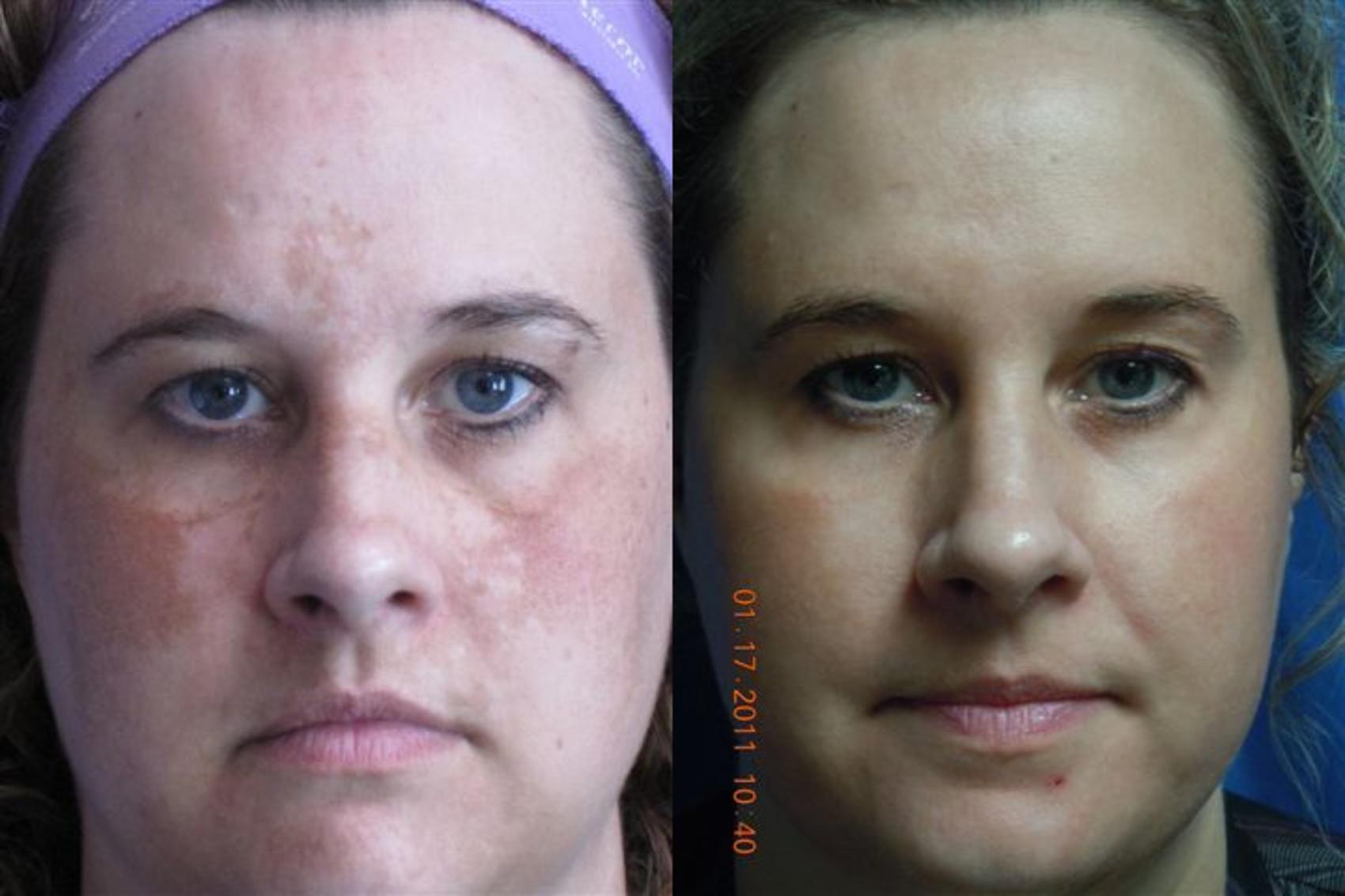 Before & After Laser Skin Rejuvenation Case 12 View #1 View in Coeur d'Alene, ID