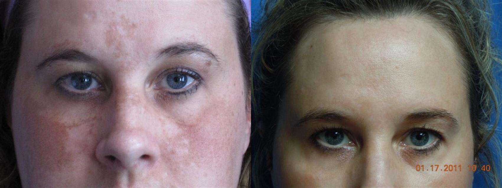Before & After Laser Skin Rejuvenation Case 12 View #2 View in Coeur d'Alene, ID