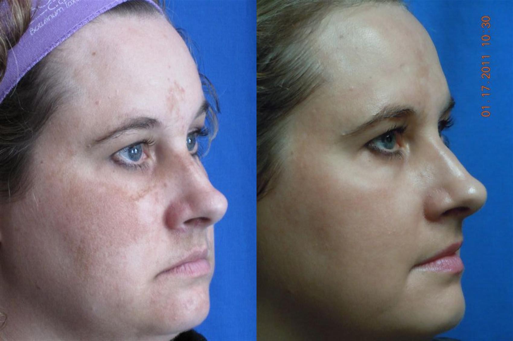 Before & After Laser Skin Rejuvenation Case 12 View #3 View in Coeur d'Alene, ID
