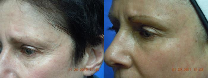 Before & After Laser Skin Rejuvenation Case 13 View #1 View in Coeur d'Alene, ID
