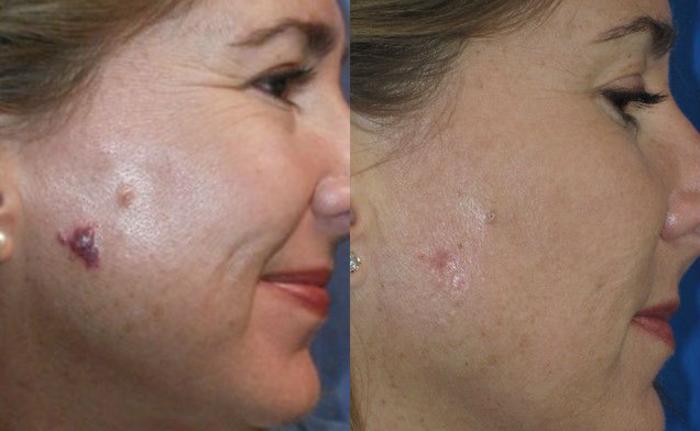 Before & After Laser Skin Rejuvenation Case 18 View #1 View in Coeur d'Alene, ID