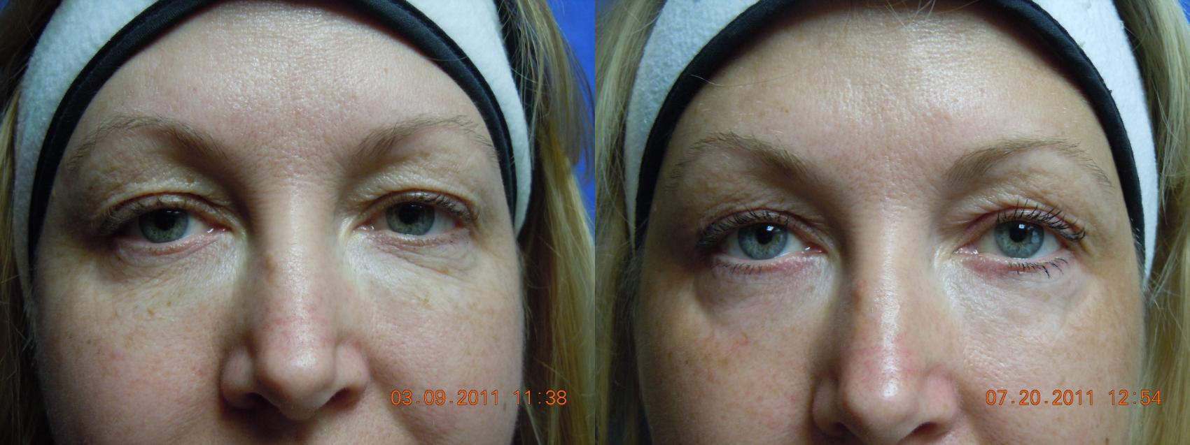 Before & After Laser Skin Rejuvenation Case 21 View #1 View in Coeur d'Alene, ID