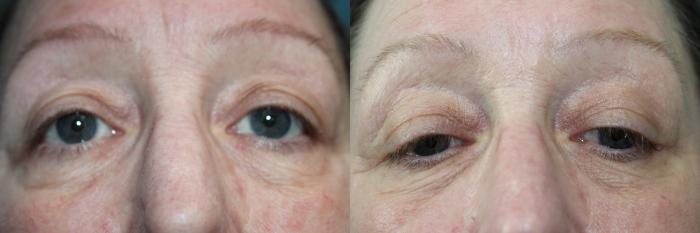 Before & After Laser Skin Rejuvenation Case 211 Eye area up close View in Coeur d'Alene, ID