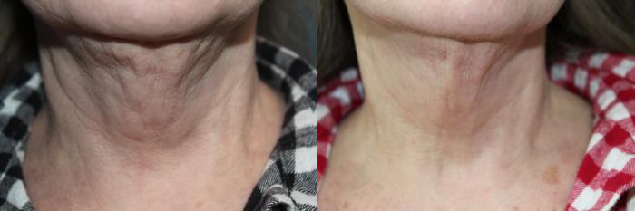 Before & After Laser Skin Rejuvenation Case 211 Front of Neck View in Coeur d'Alene, ID