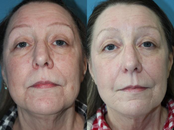 Before & After Laser Skin Rejuvenation Case 211 Front View in Coeur d'Alene, ID