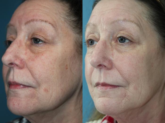 Before & After Laser Skin Rejuvenation Case 211 Left Oblique View in Coeur d'Alene, ID